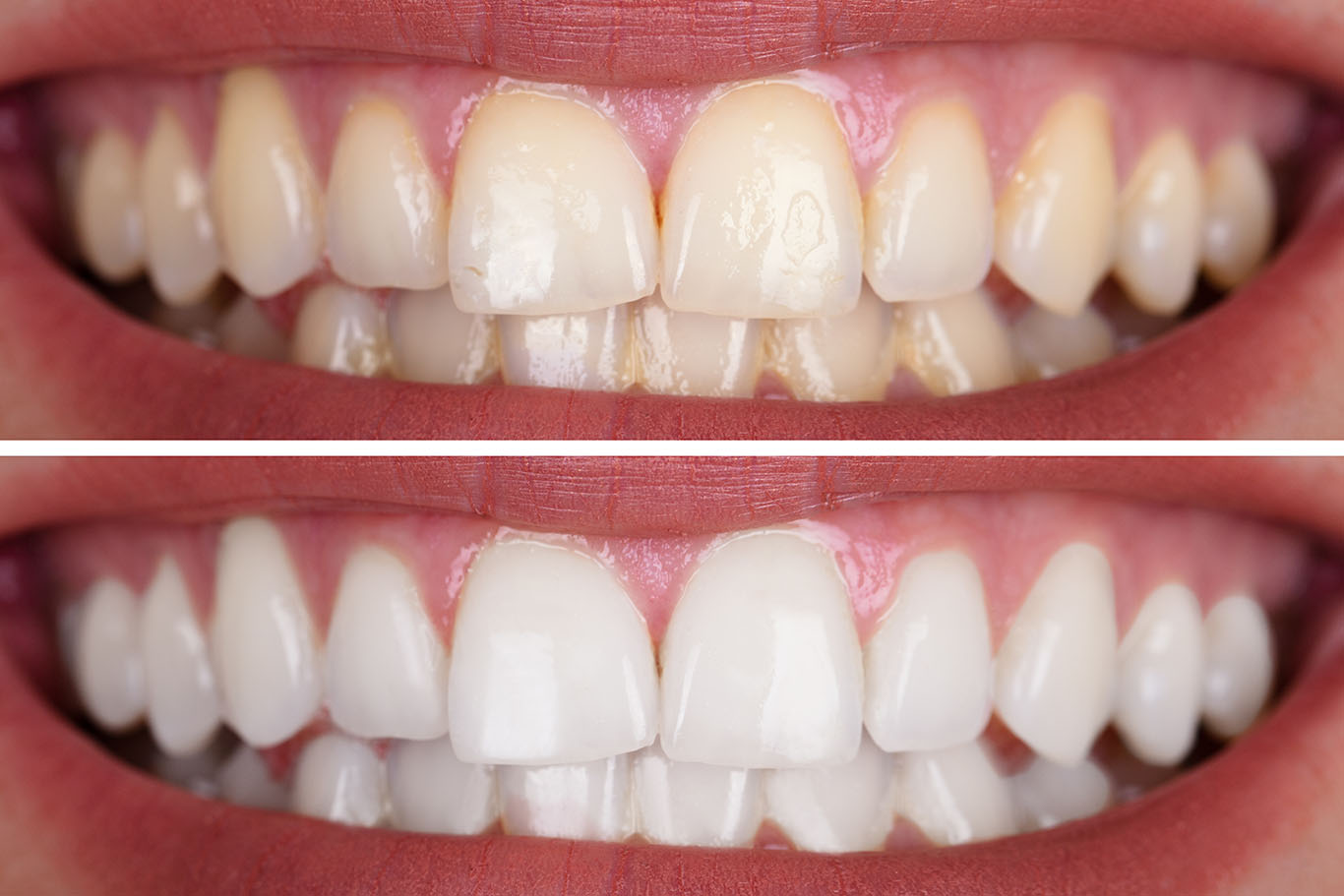 The Difference With Professional Whitening