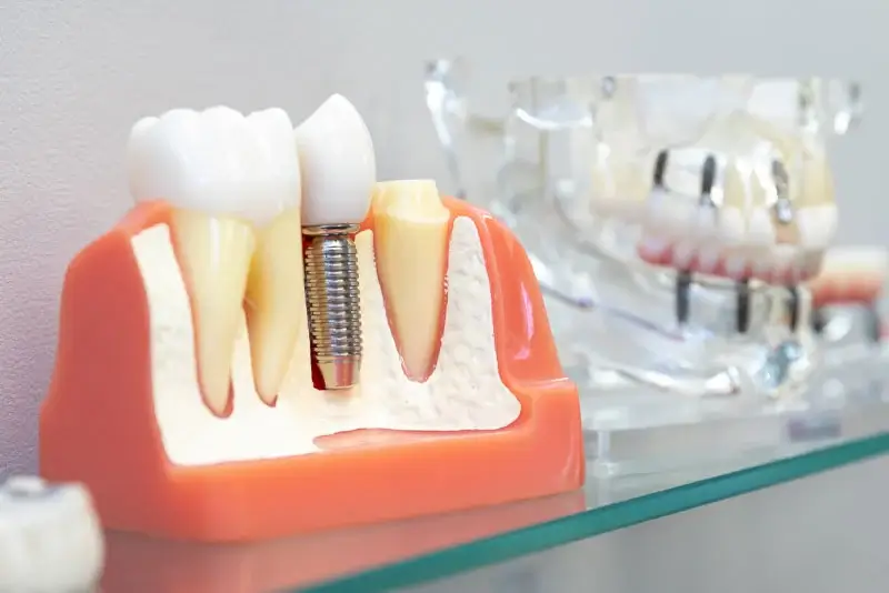 dental implants