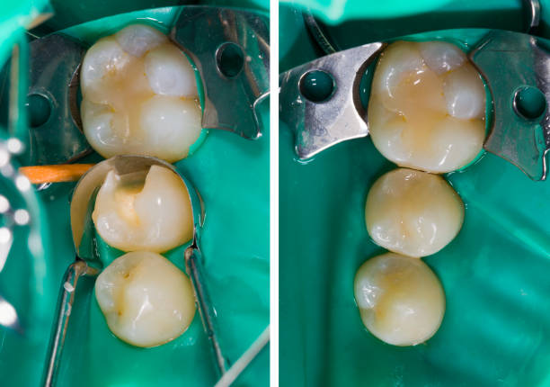a comparison photo of the before and after of composite fillings