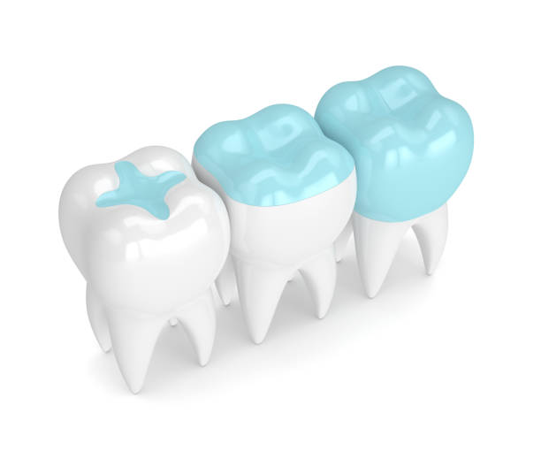 a digital image of tooth with fillings