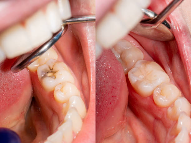 photo showing the before and after of fillings
