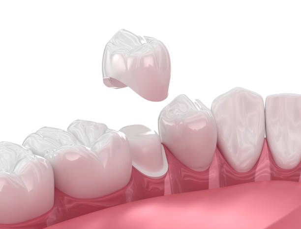 a photo showing how a CEREC crown is placed on the teeth