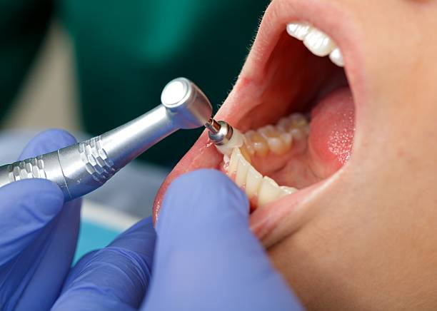 close-up shot of a patient's teeth during dental cleaning