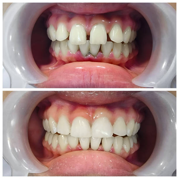 teeth before and after cosmetic dental procedure