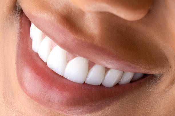 close-up photo of teeth with veneers