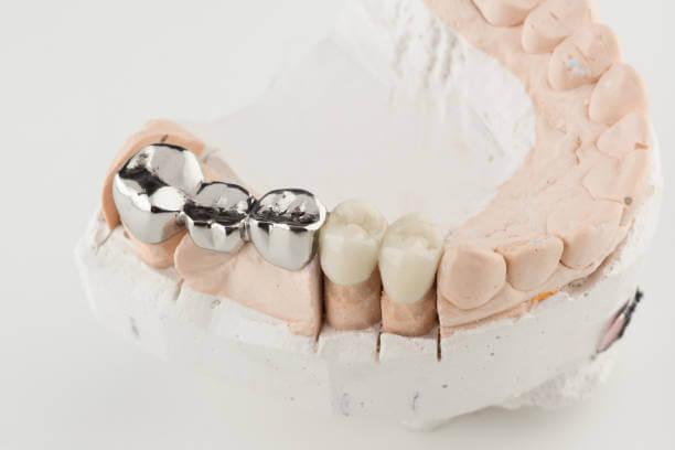 A close-up image of a teeth model with a shiny metal dental crown placed on molars.