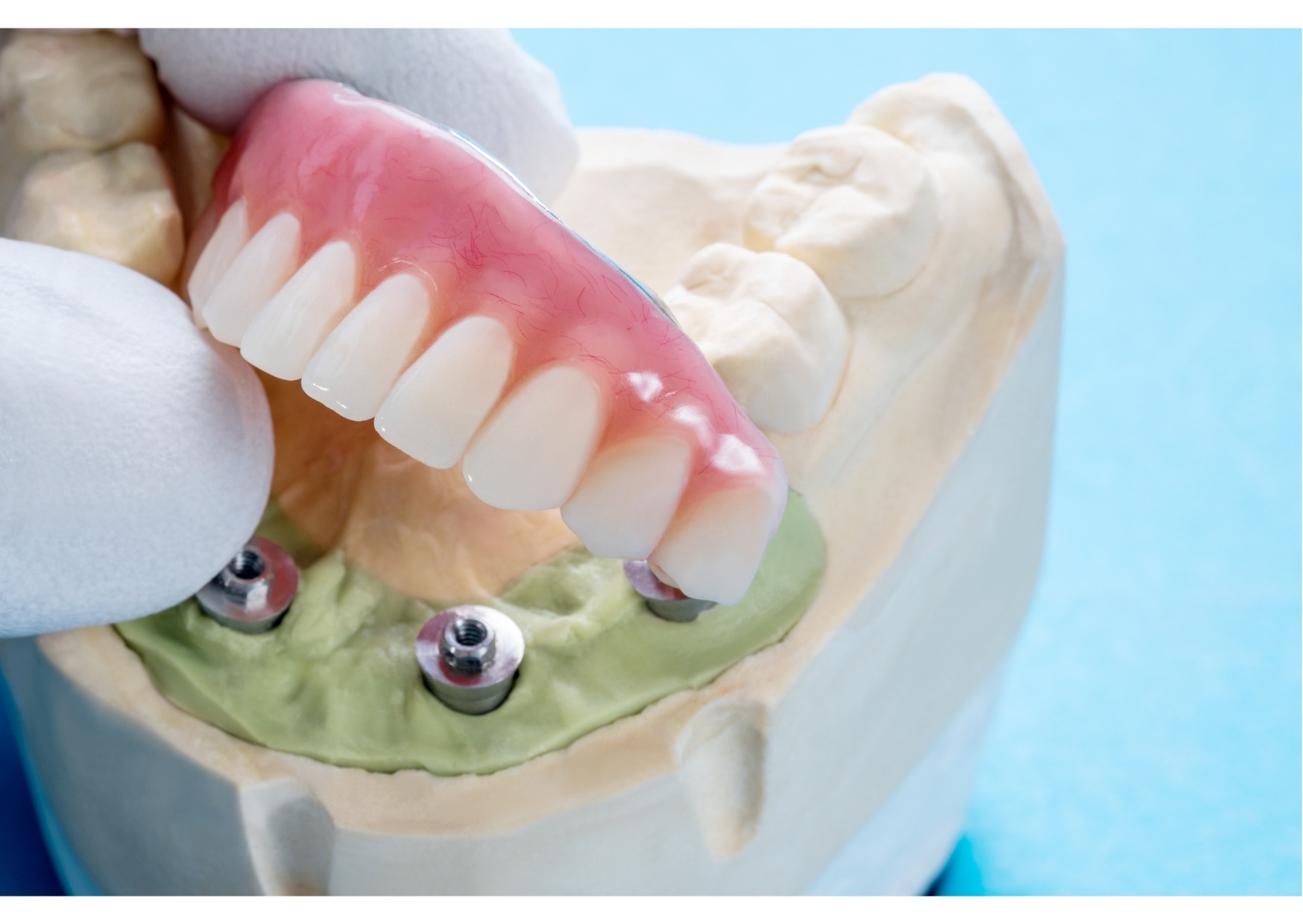 Close-up of dental implant-supported denture model showing full arch restoration, illustrating cost of dental implants.