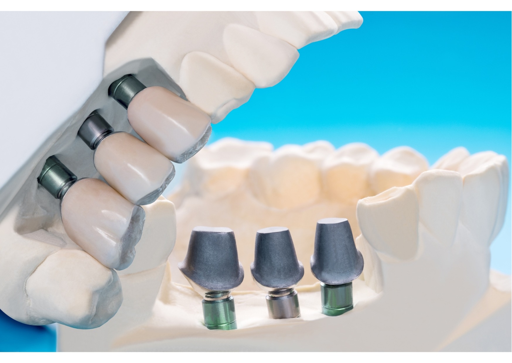 Close-up of multiple dental implants with abutments and crowns on a jaw model demonstrating implant-supported tooth replacement.