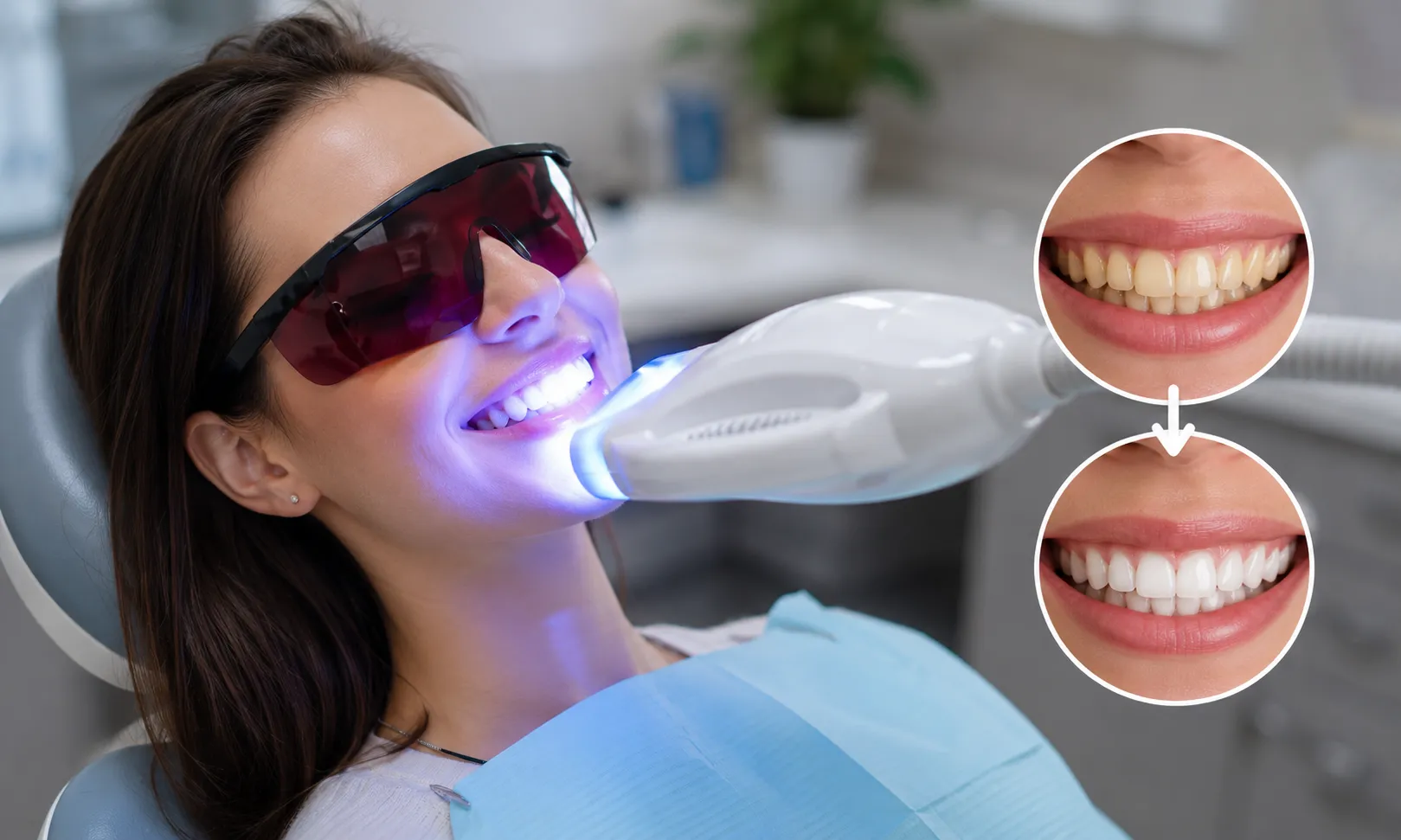 Patient receiving professional teeth whitening treatment with before-and-after smile results