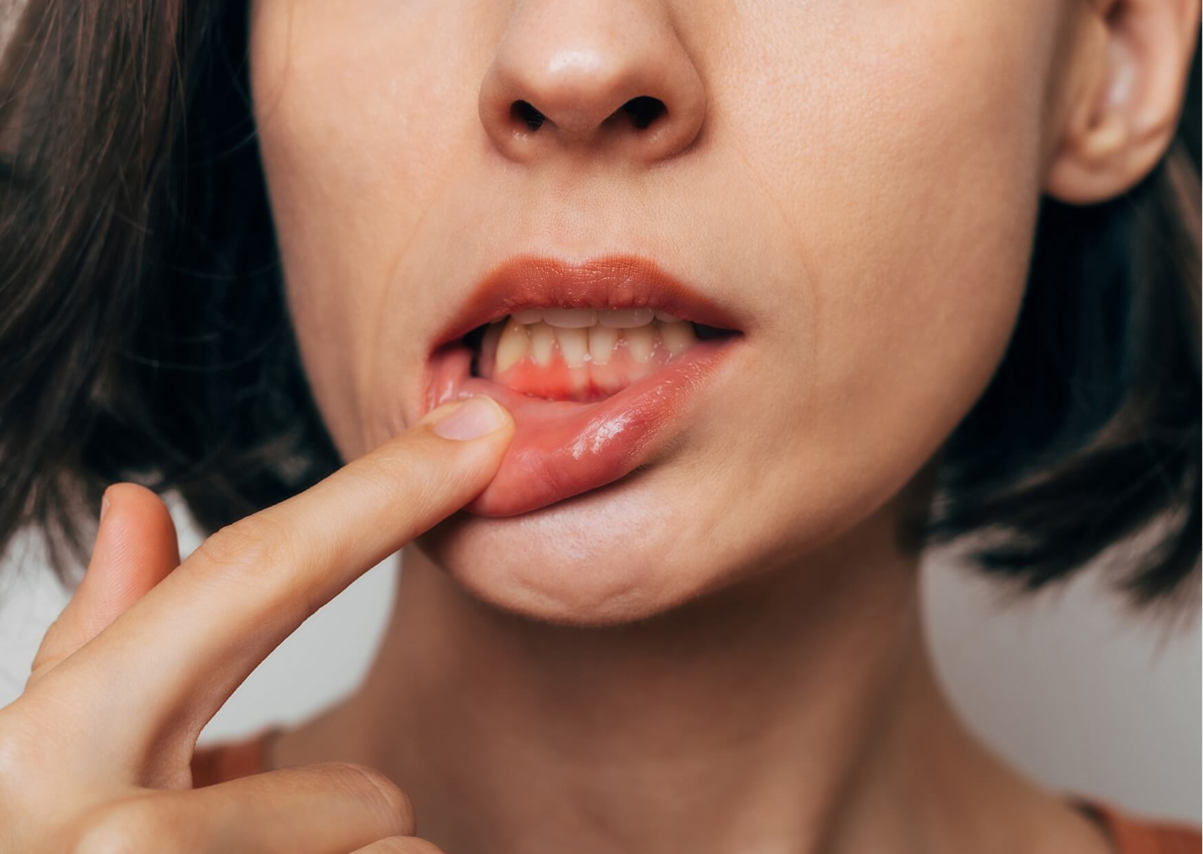 Close-up of red, swollen gums caused by gingivitis, showing common symptoms such as inflammation, tenderness, and gum irritation.