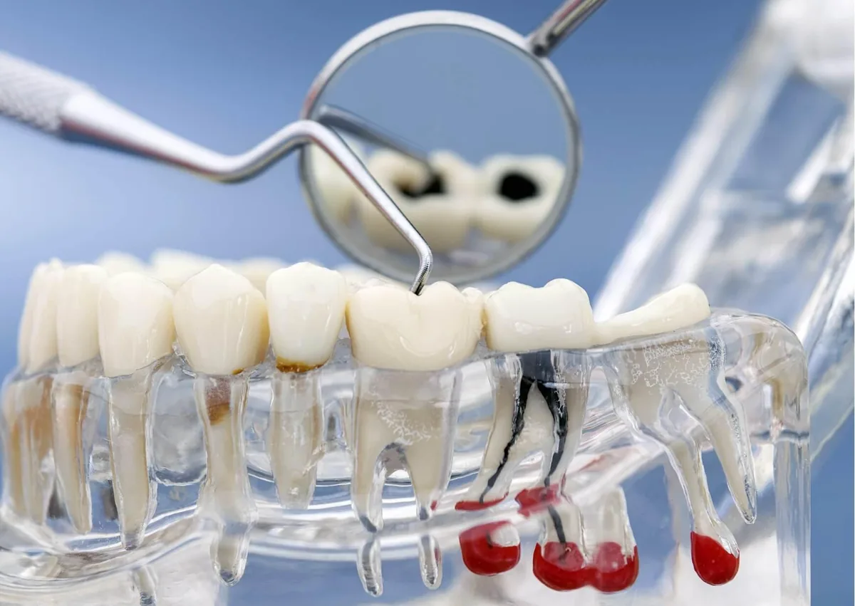 Dental model showing tooth decay and cavities forming in different stages.