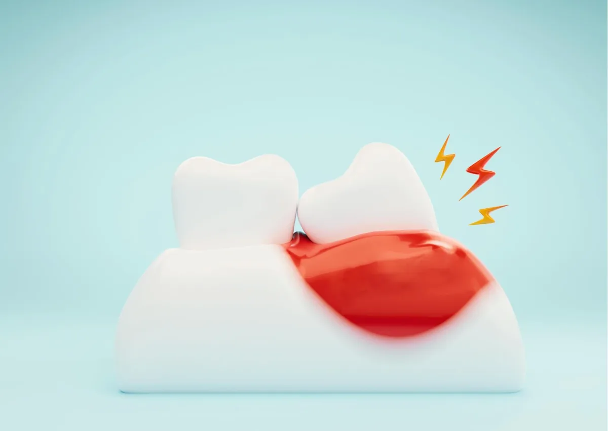 Illustration of red, swollen gums around a tooth showing discomfort and inflammation.