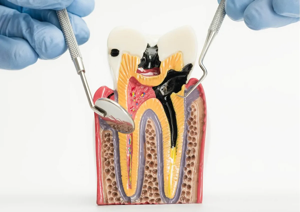 Cross-section dental model showing tooth decay and cavities extending into deeper layers of a tooth.