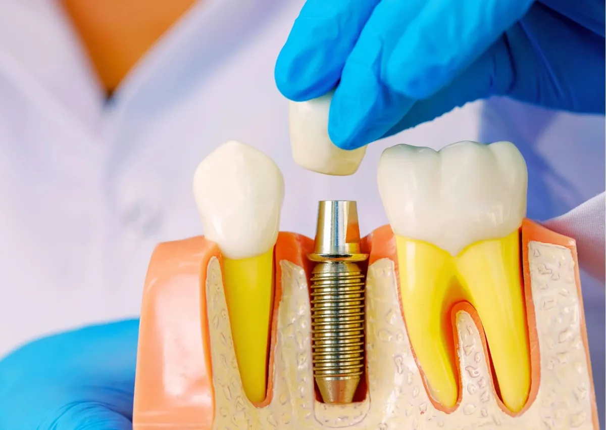 Dental implant model showing the implant post and crown as an affordable tooth replacement option.
