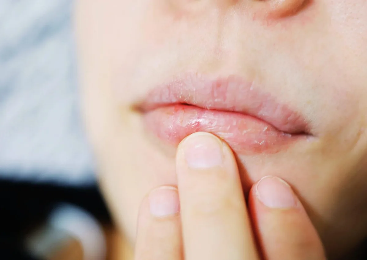 Close-up of dry, irritated lips showing a common symptom associated with persistent dry mouth.